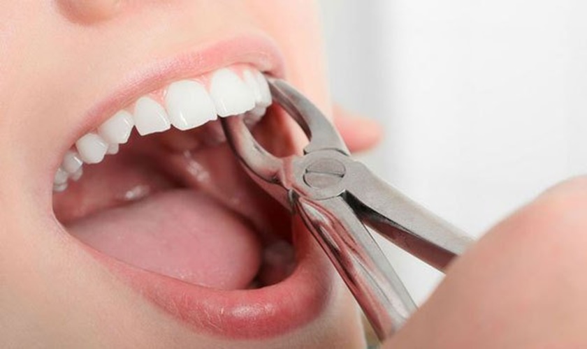Giải đáp: Nhổ răng sâu hàm trên ở đâu?