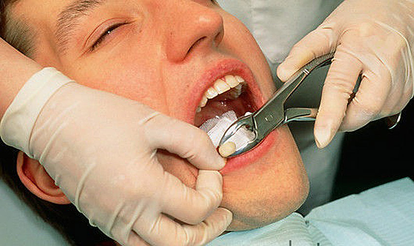 Nhổ răng kiêng gì? Nhổ răng trong những trường hợp nào?	