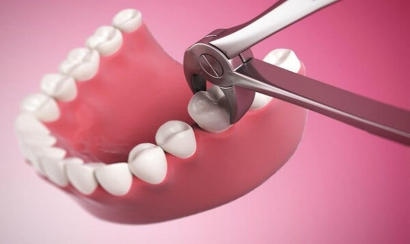 Nhổ răng phẫu thuật phải không?
