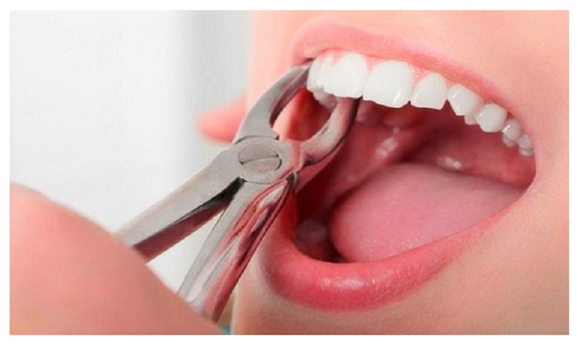 Thắc mắc: Nhổ răng mấy ngày thì lành? Lưu ý gì sau khi nhổ răng?