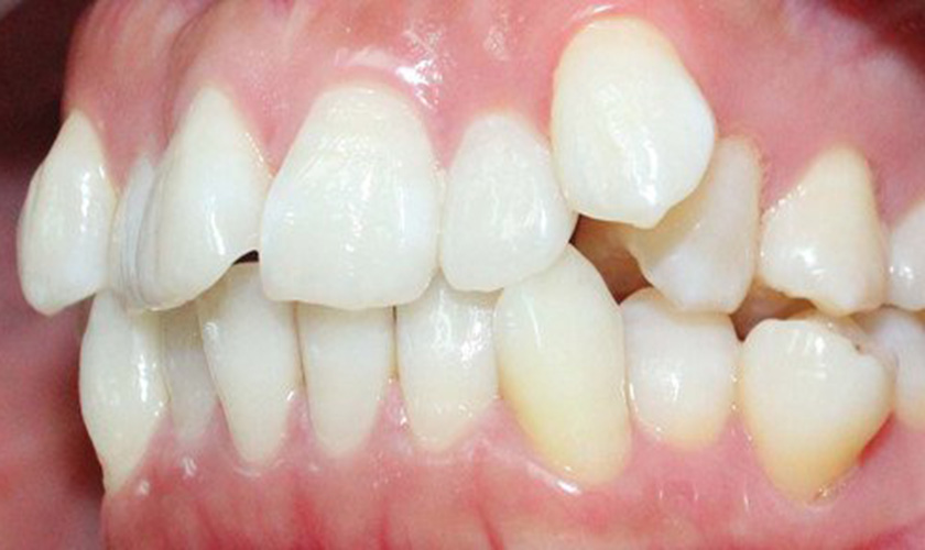 Thắc mắc: Răng mọc lệch có nguy hiểm không? Nên nhổ răng mọc lệch không?