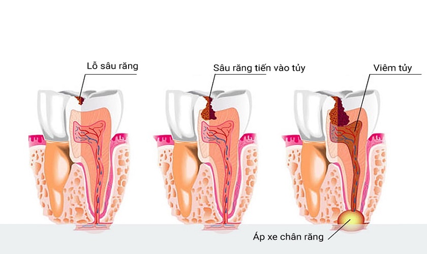 Trả lời thắc mắc: Nhổ răng hàm bị sâu có đau không? Chú ý gì sau khi nhổ răng? Trả lời thắc mắc: Nhổ răng hàm bị sâu có đau không? Chú ý gì sau khi nhổ răng?