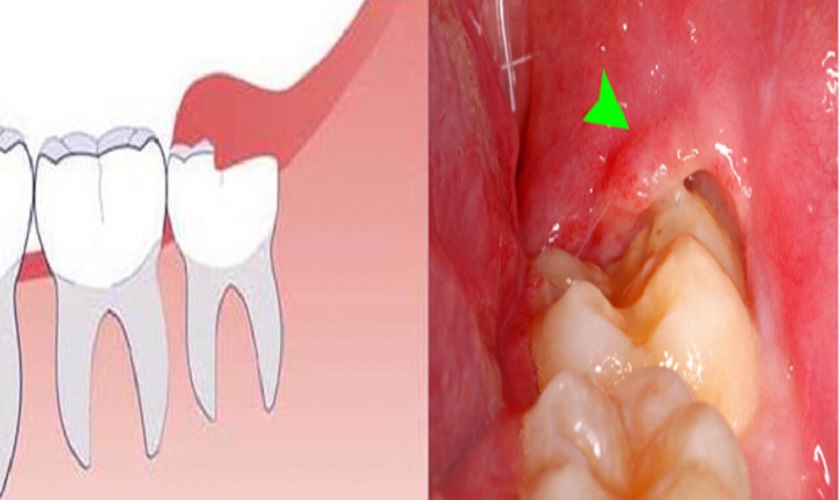 Cần biết sau nhổ răng khôn uống thuốc gì?