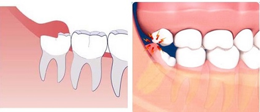 Răng khôn cần nhổ bỏ nếu gây đau nhức khi nhai