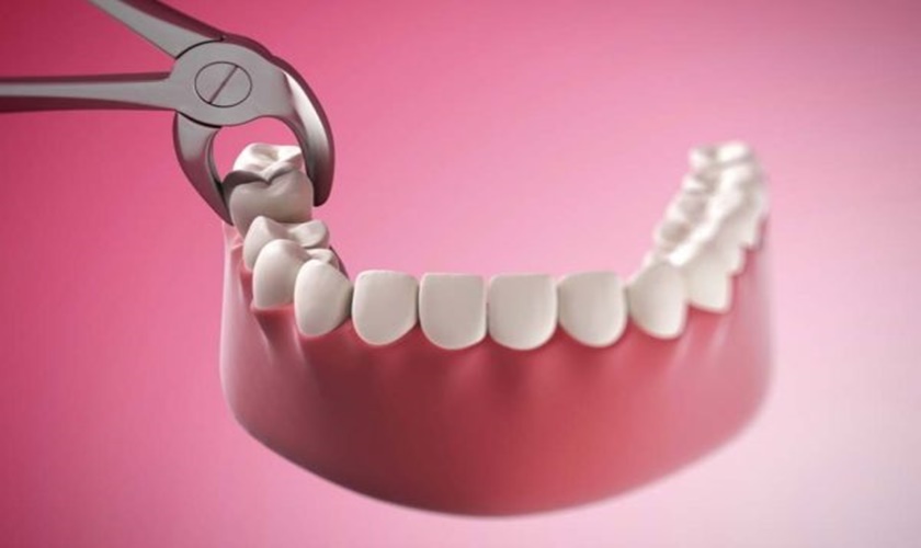 Nhổ 2 răng số 8 cùng lúc được không? Quy trình nhổ 2 răng số 8 cùng lúc thế nào?