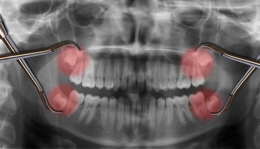 Bệnh nhân có thể nhổ 2 răng số 8 cùng lúc